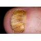 Scholl Fungal Nail ničí 99.9%mykózu nechtov.